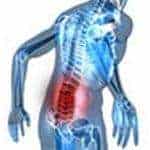 Rhematoid Arthritis in the Back